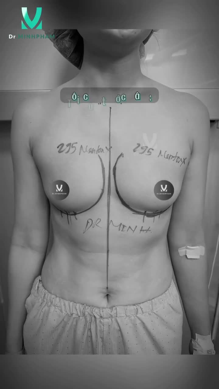 Nhìn lại quá khứ để thấy quyết đinh nâng nấp V1 tại Dr. Minh Phạm là đúng đắn