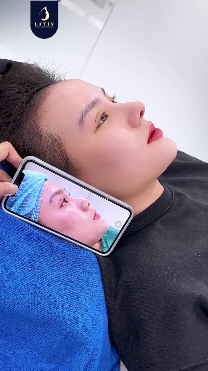 TÁI KHÁM SAU  10 NGÀY CẮT CHỈ – DÁNG MŨI CAO BAY VÀO FORM ĐẸP TỰ NHIÊN