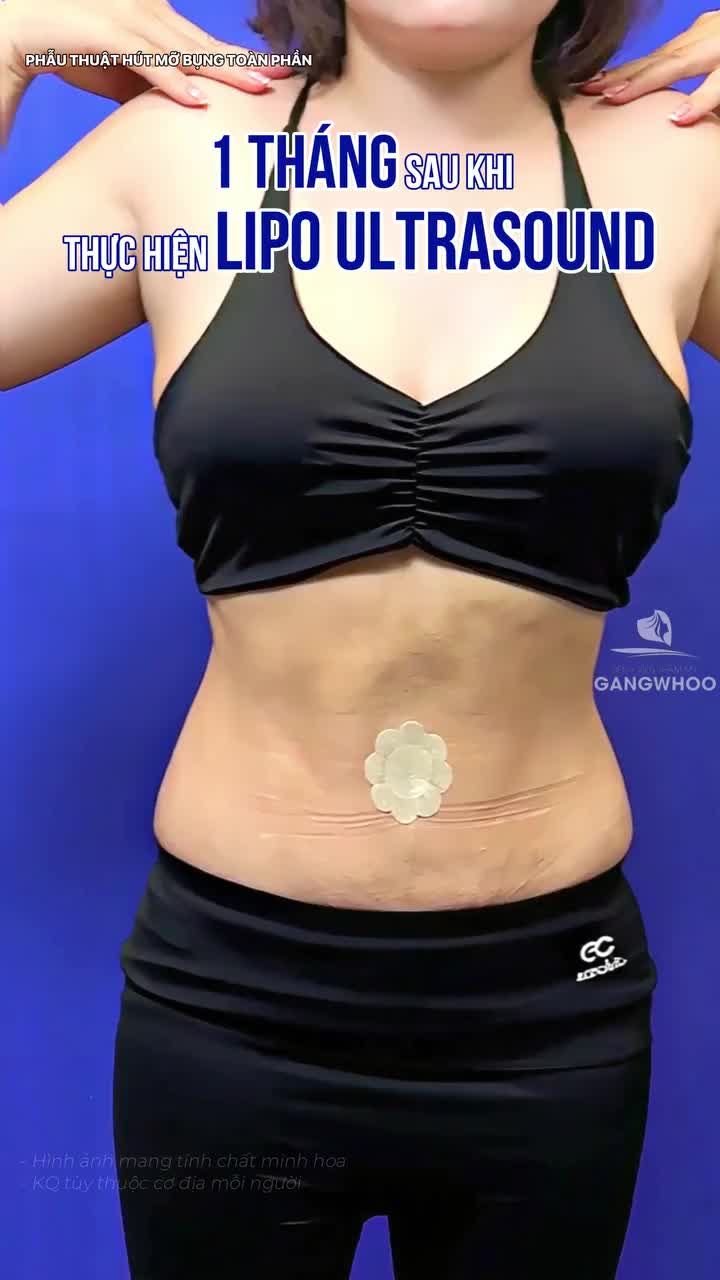Những con số biết "chứng minh" sau giảm mỡ 1 tháng công nghệ Lipo Ultrasound của chị khách