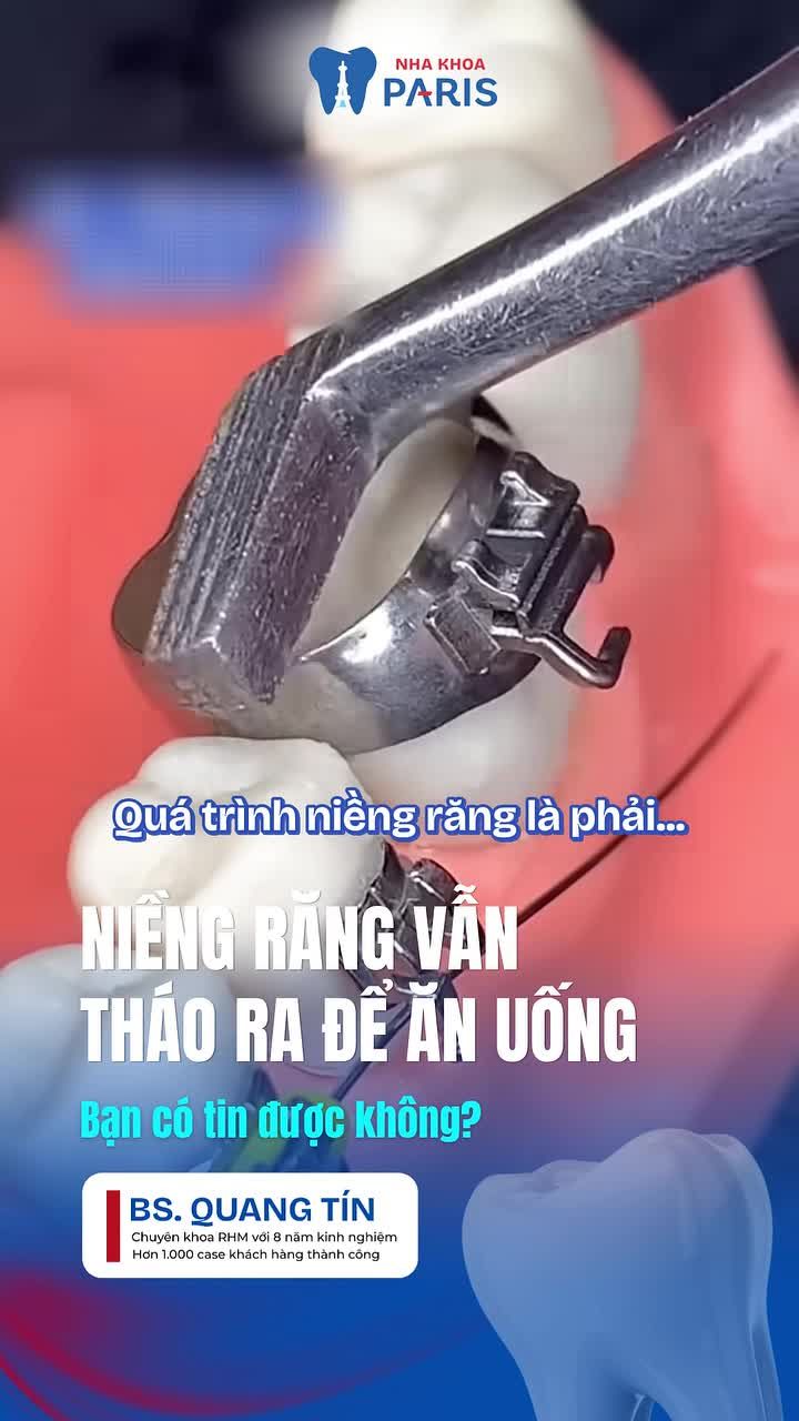 NIỀNG RĂNG MÀ VẪN THÁO RA ĐƯỢC KHI ĂN – TIN ĐƯỢC KHÔNG?