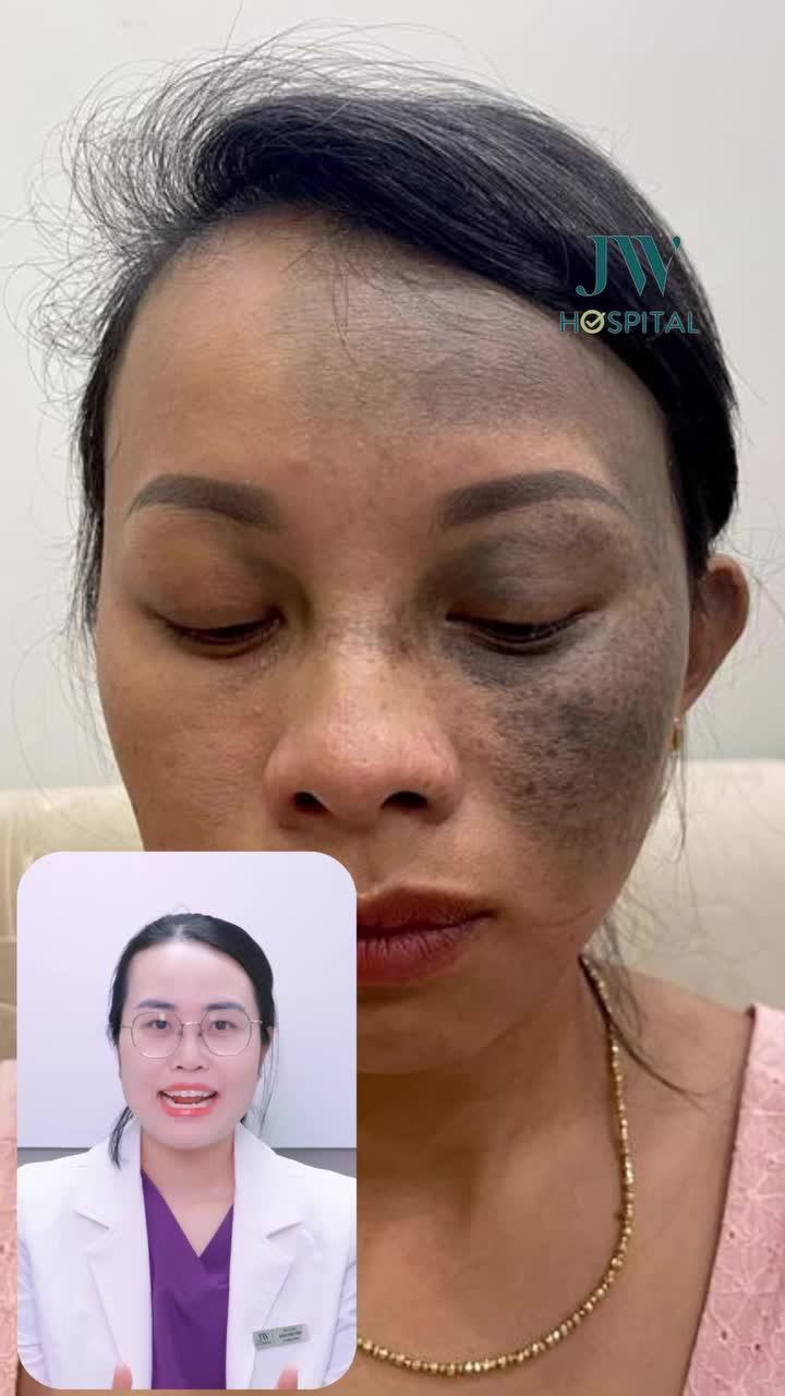 TIN ĐƯỢC KHÔNG? TRỊ HẾT 100% BỚT OTA VỚI LASER 3S PLUS BÁC SĨ JW GIẢI ĐÁP