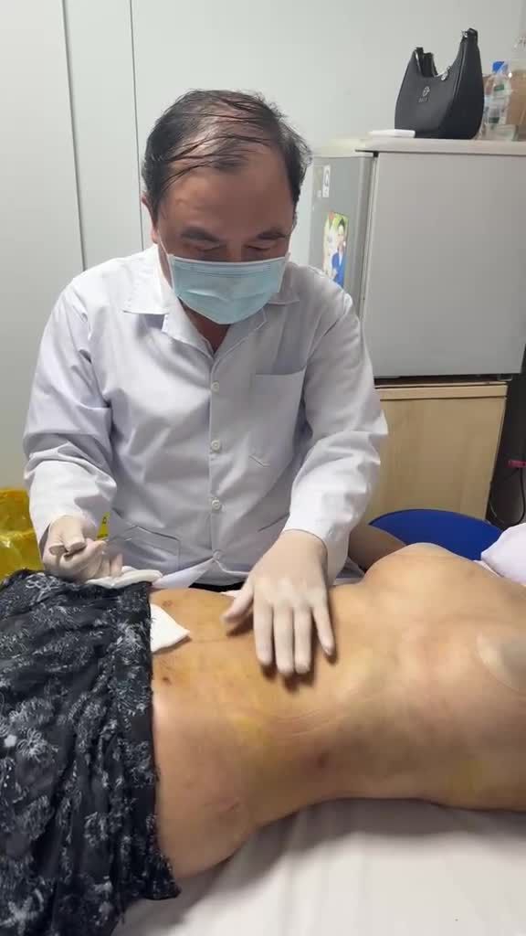 Khám lại cho bạn khách HN sau hút mỡ 10 ngày cắt chỉ !