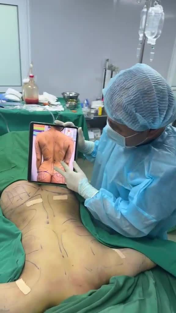Xử trí Ụ gáy hút mỡ cánh tay nách, lưng, eo rồi cấy mỡ mông với Dr Vương