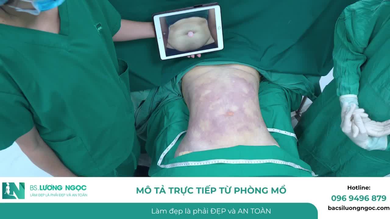 VÒNG BỤNG 1M GHI NHẬN THAY ĐỔI GẦN 20CM SAU 2 GIỜ THỰC HIỆN