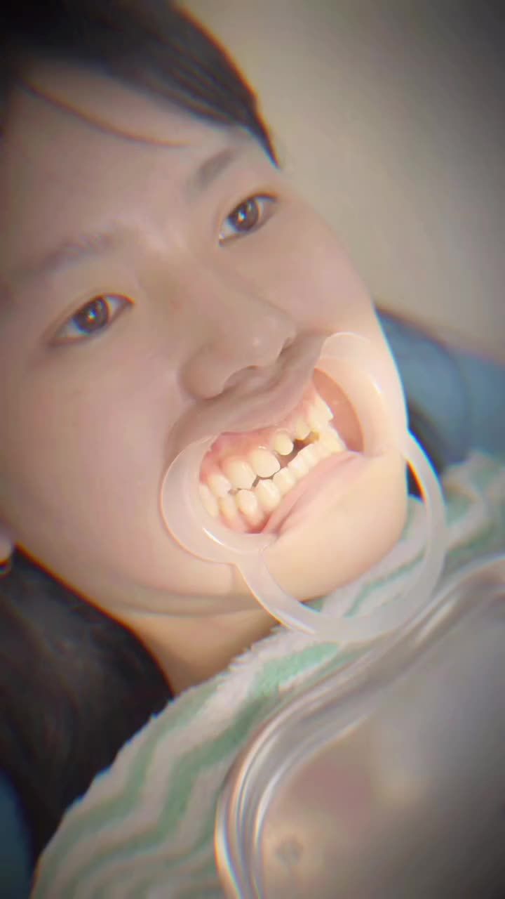 LÊN RĂNG SỨ DÁNG RĂNG THỎ TỰ NHIÊN CHO BÉ 2k8