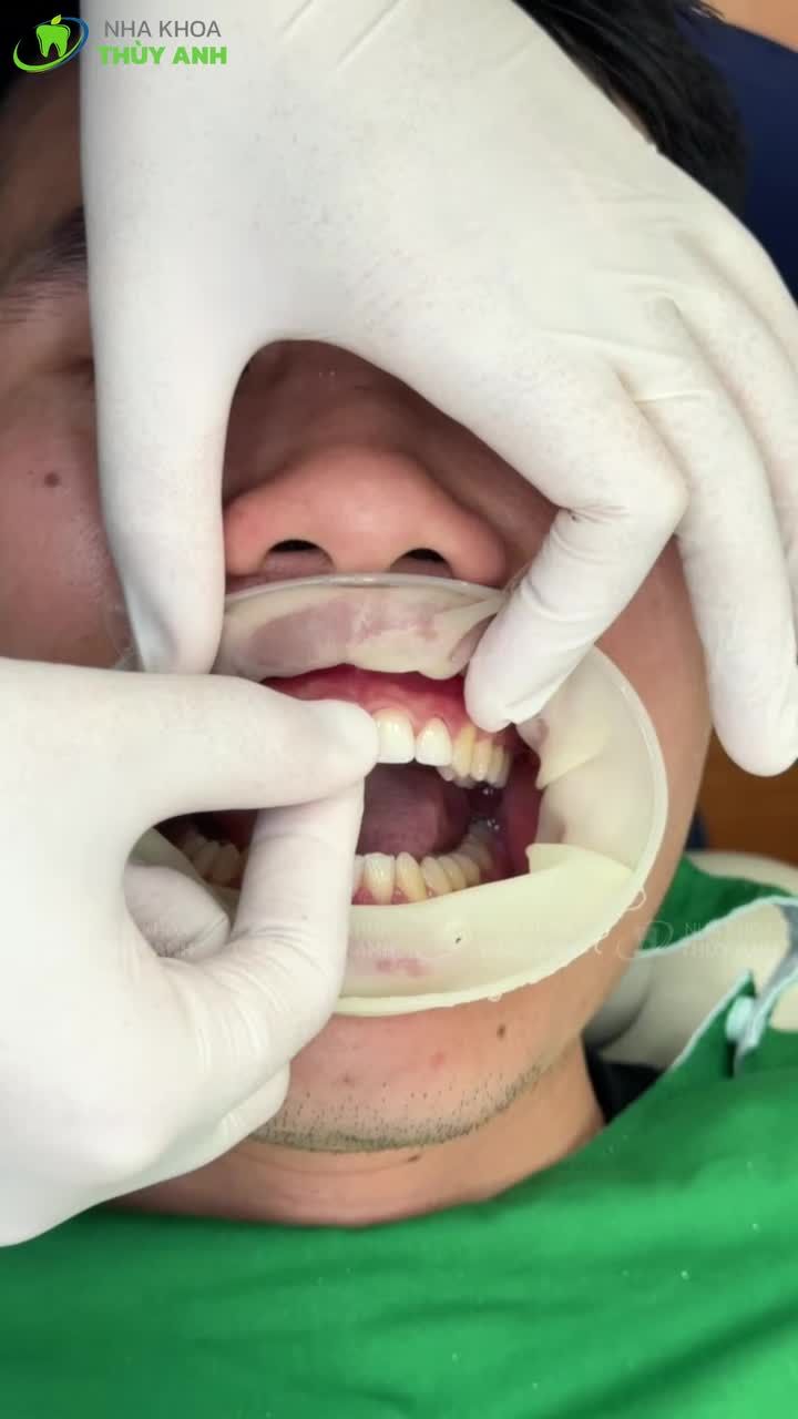 Xem thêm 103 video Mặt Dán Sứ Veneer của bác sĩ Bs nha khoa Thùy Anh