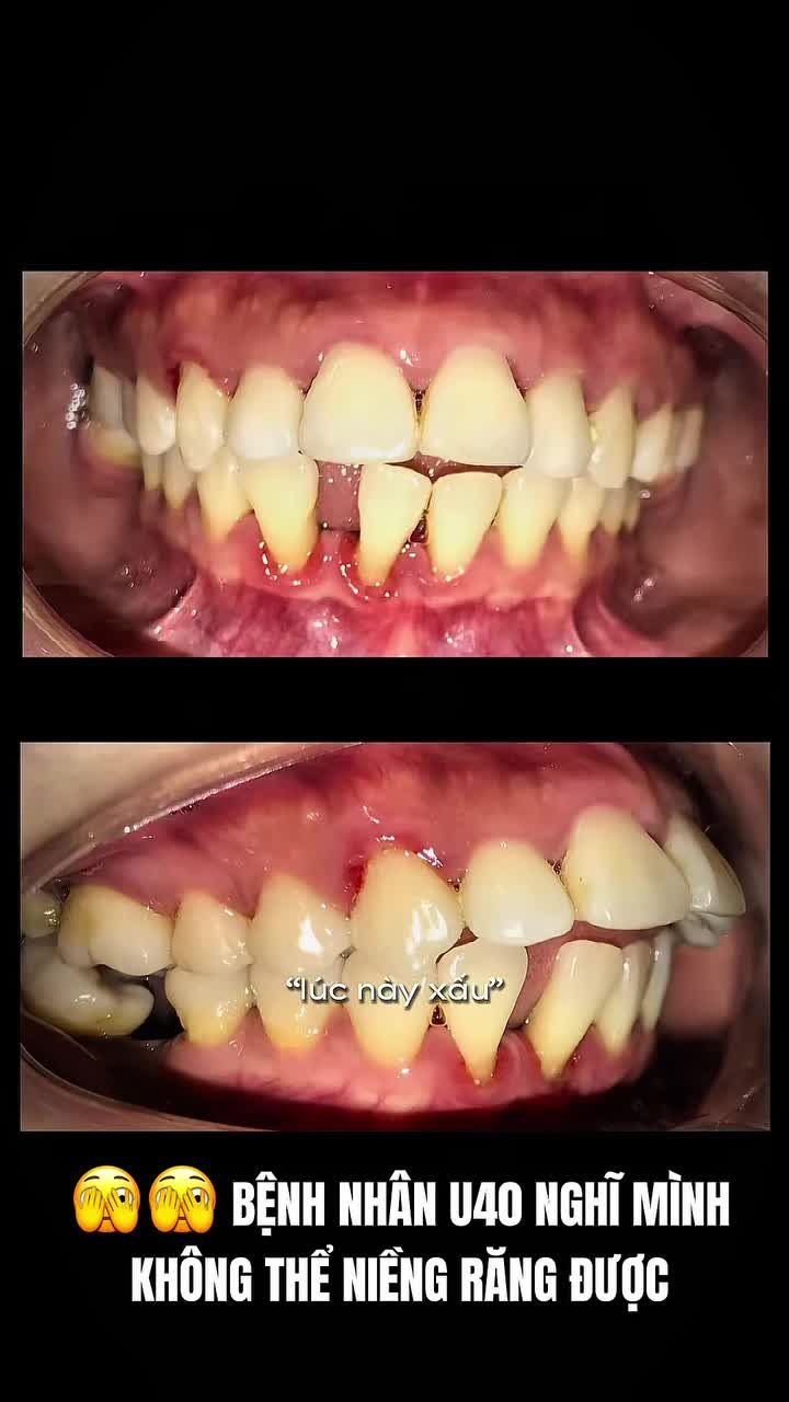 U40 – bệnh nhân đến khám với lo lắng phải nhổ răng cửa hàm dưới do tình trạng nha chu tiến triển.