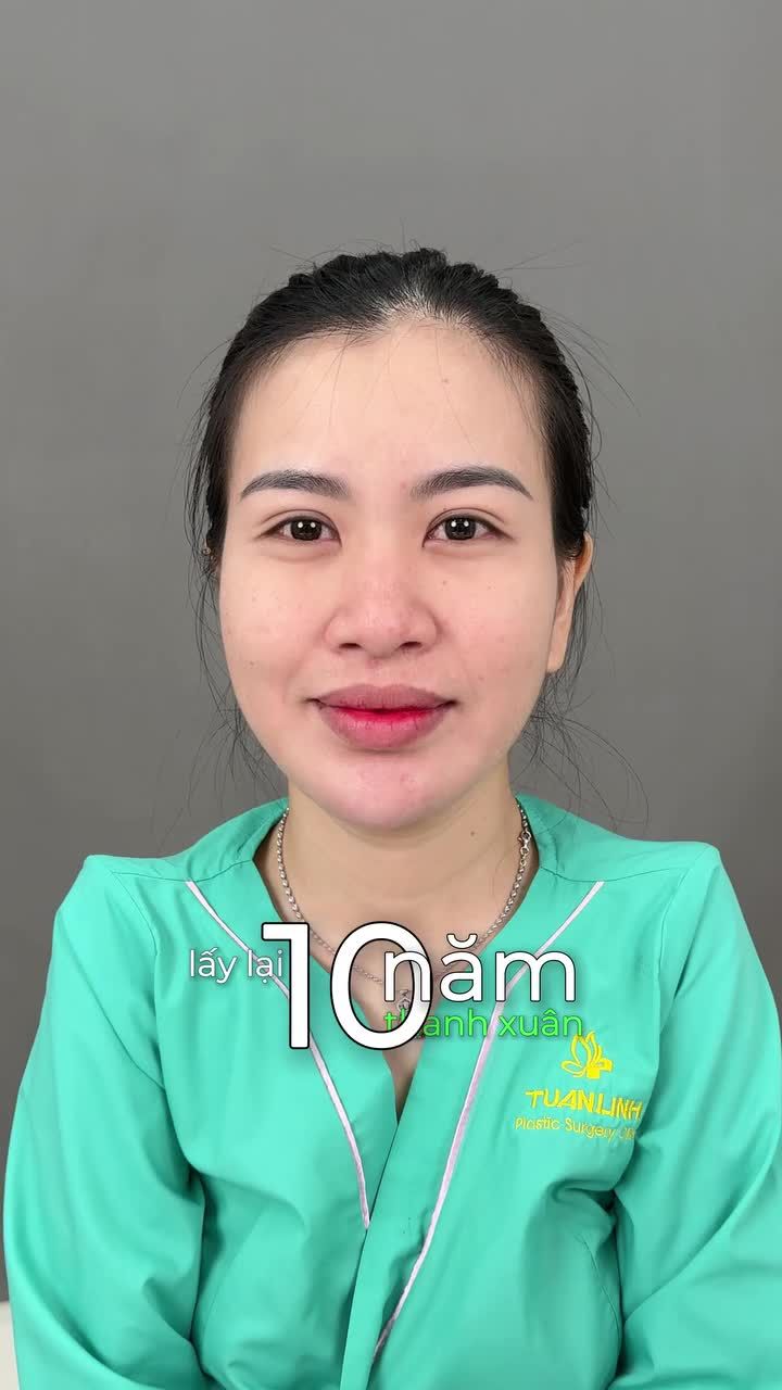LẤY LẠI 10 NĂM THANH XUÂN NHỜ DÁNG MŨI