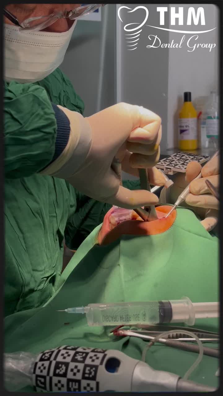 IMPLANT ALL ON 6 Được thực hiện bởi: Ths. Bs. Trần Văn Vui.