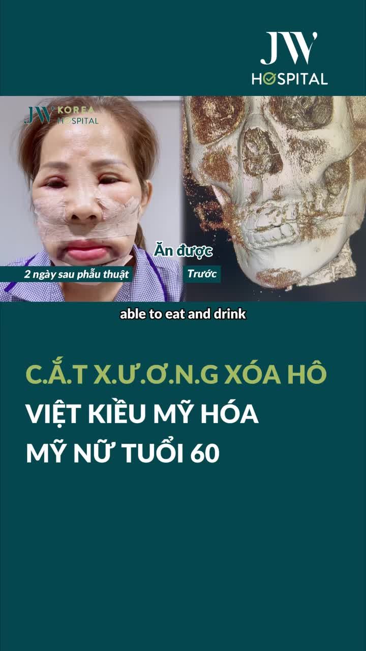 NỮ VIỆT KIỀU 60 TUỔI CHI MẠNH TAY 150 TRIỆU BAY TỪ MỸ ĐẾN GẶP BÁC SĨ TÚ DUNG CẮT XƯƠNG HÀM HÓA MỸ NỮ