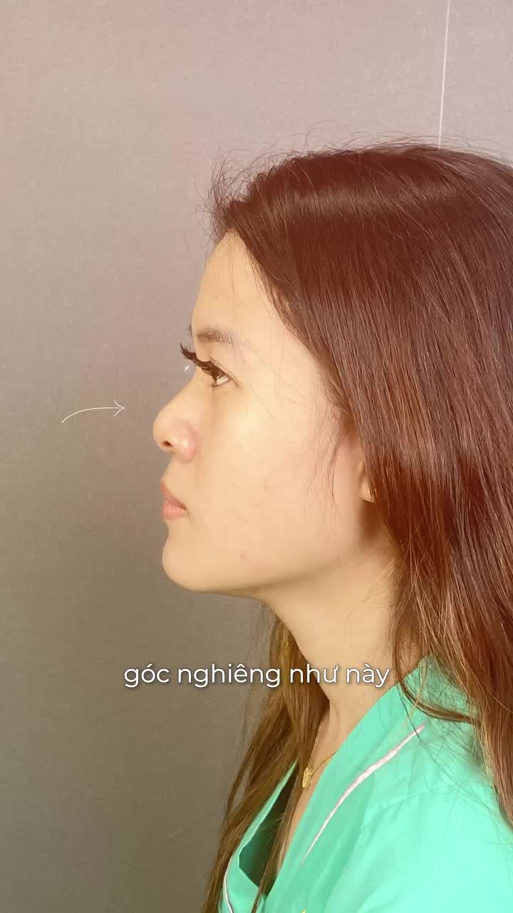 NÂNG MŨI CẤU TRÚC – DÁNG THIẾT KẾ RIÊNG CHO TỪNG GƯƠNG MẶT