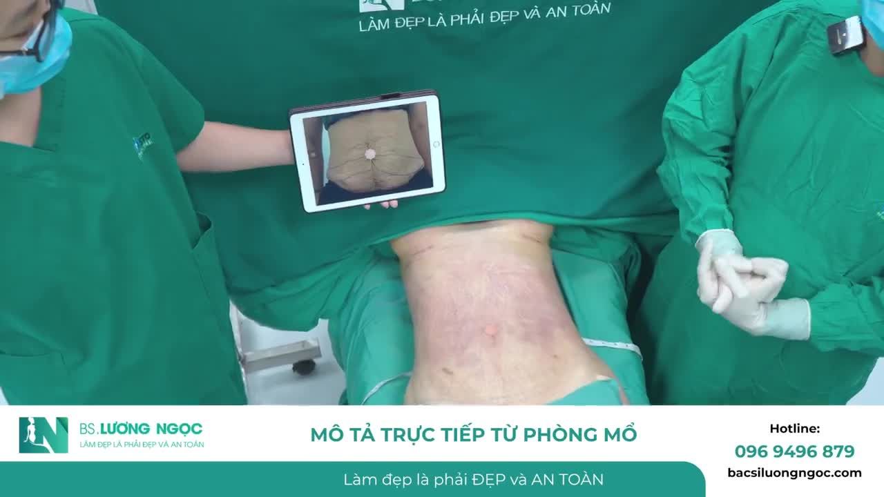 VÙNG DA BỤNG NHĂN VÀ CHÙNG NHÃO CÓ THỂ CẢI THIỆN SAU HÚT MỠ, TIN ĐƯỢC KHÔNG?