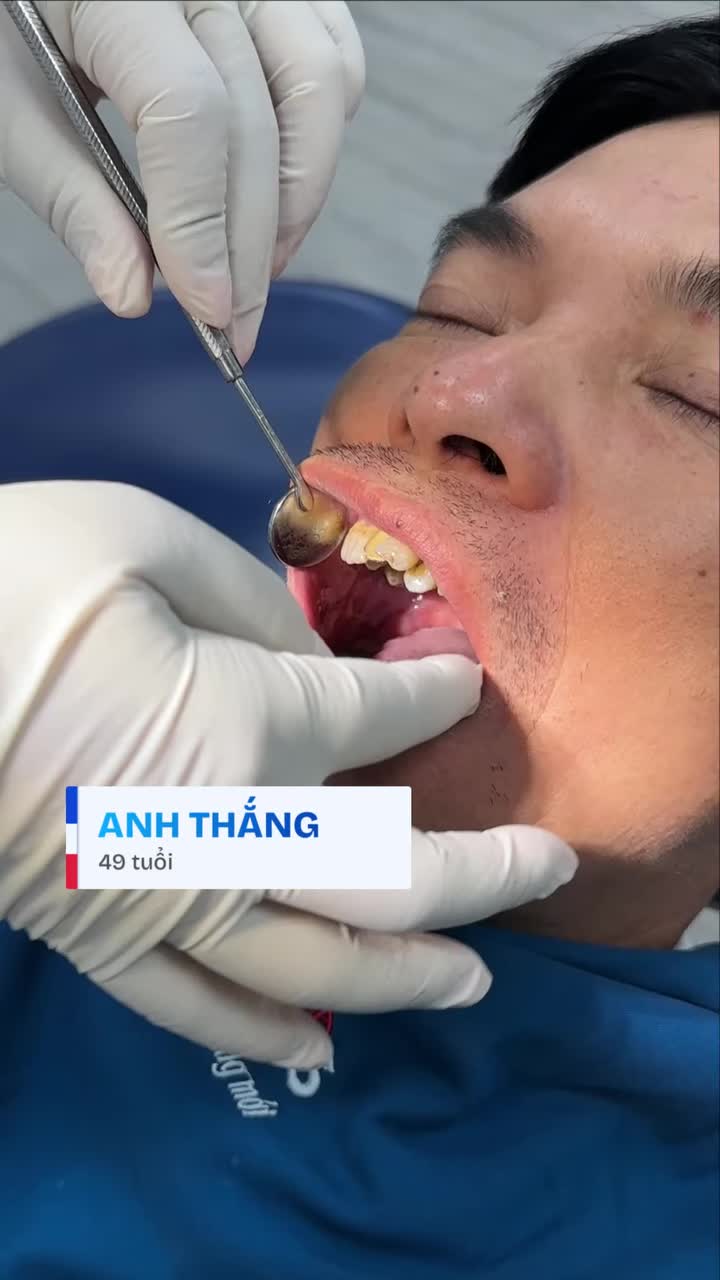 MẤT TRẮNG HÀM RĂNG Ở TUỔI 40 VÌ VIÊM NHA CHU – LIỆU TIÊU XƯƠNG NẶNG CÓ PHẢI LÀ DẤU CHẤM HẾT CHO NỤ CƯỜI?"