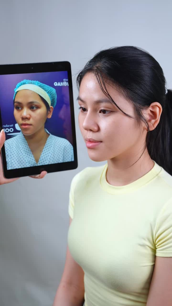 TÁI KHÁM SAU 3 THÁNG NÂNG MŨI: CÔ NÀNG GEN Z "LỘT XÁC" XINH ĐẸP RẠNG NGỜI!