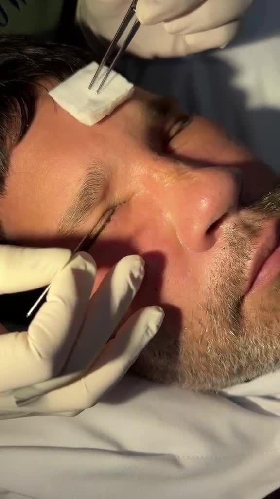 NGOẠN MỤC: Quý ông U50 bay 15.000km từ Mỹ đến JW XÓA SỔ 10 NĂM LÃO HÓA chỉ với Cấy m.ỡ và Midface 3 in 1