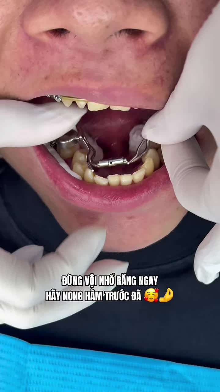 Khí cụ nong hàm là gì ?. Công dụng ra sao?