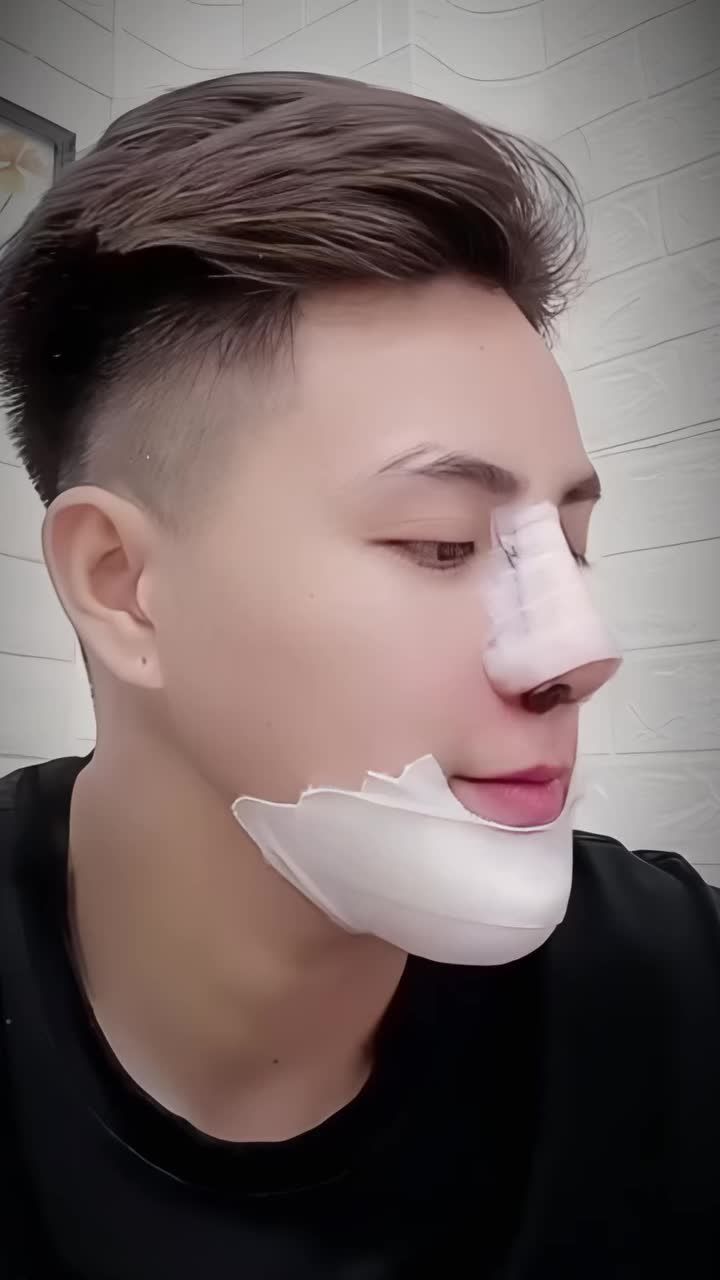 Transguy Bình Dương "lên hạng" diện mạo - góc cạnh và nam tính hơn với combo mũi - cằm.