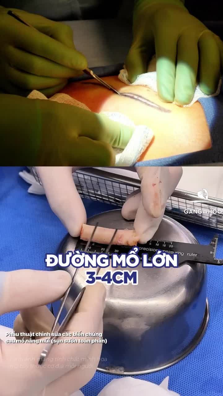 Sụn sườn tự thân, cứu tinh cho những chiếc mũi hỏng