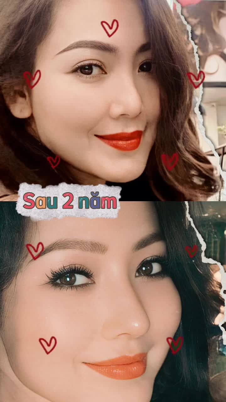 Trẻ hơn sau nâng mũi, bạn có đồng ý không? Đừng ngại để AZNOSE đồng hành trong hành trình thay đổi của bạn nhé!