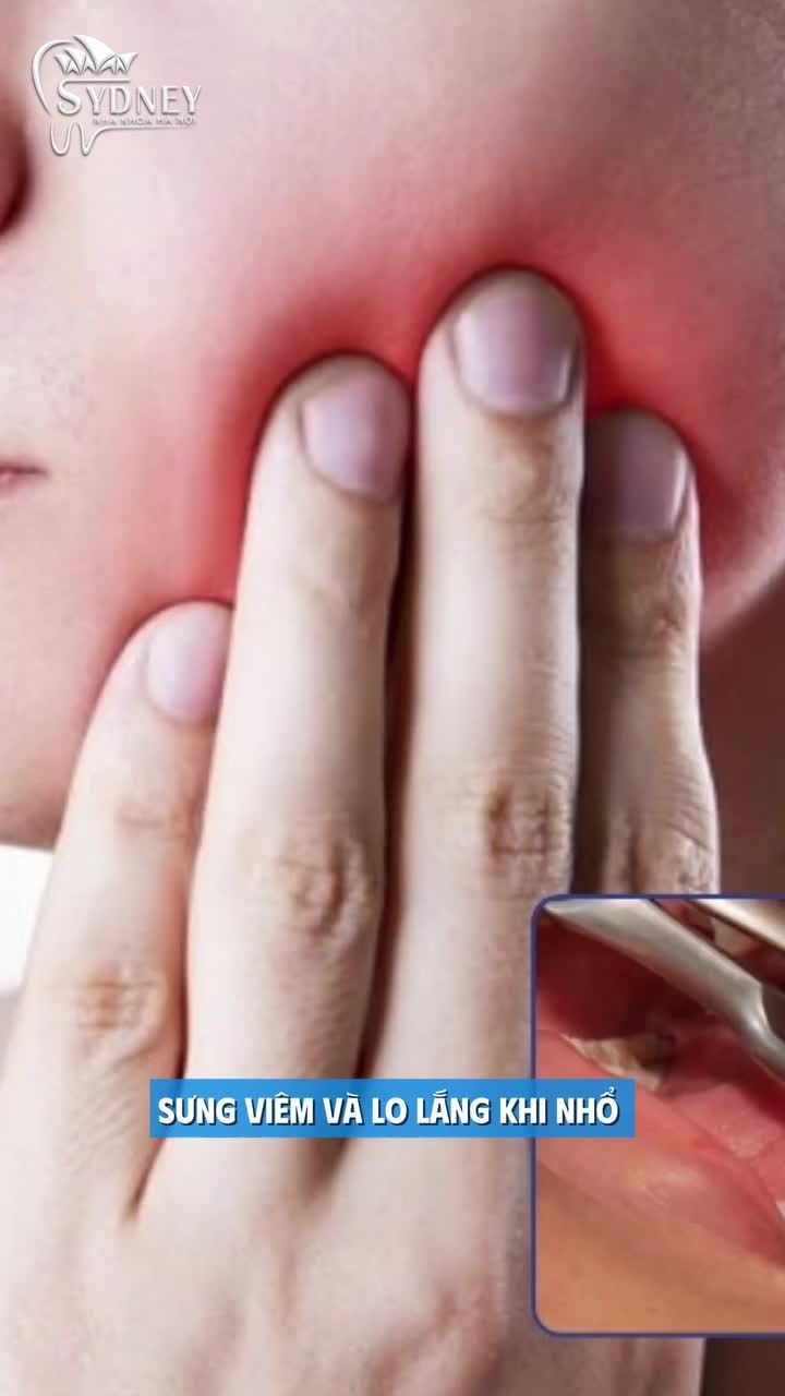 Tại sao răng khôn lại khó nhổ?