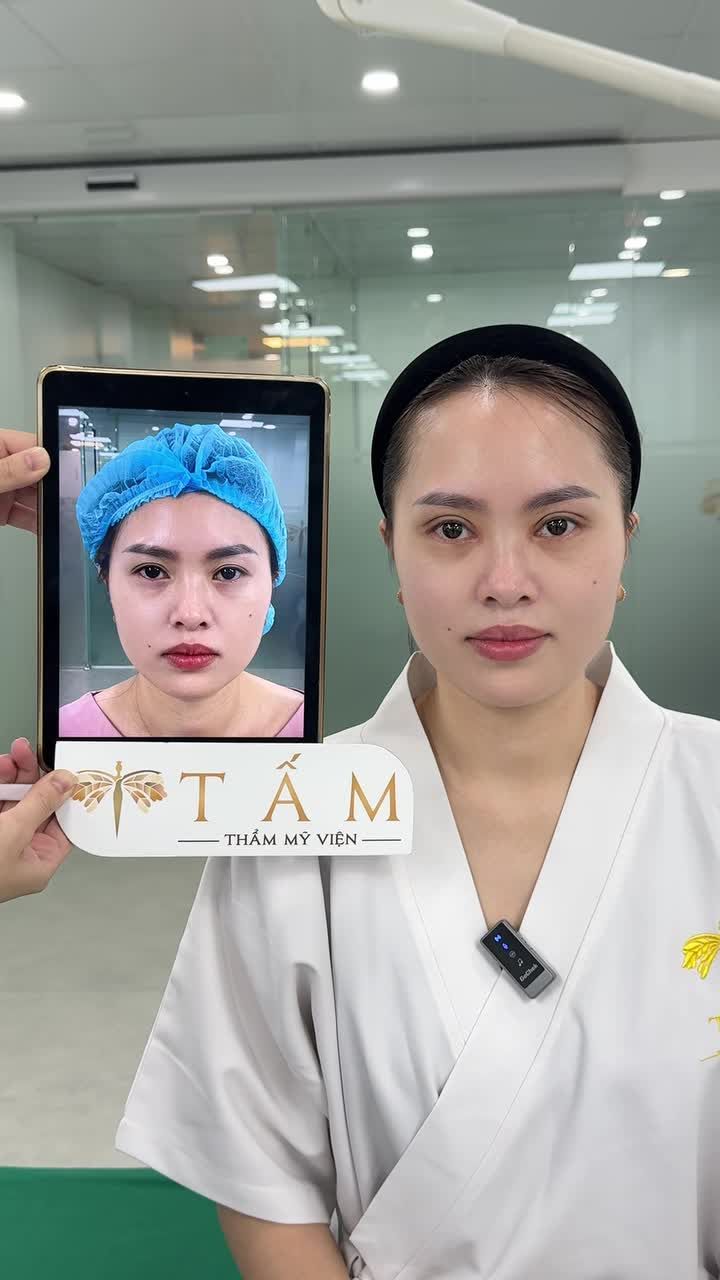 Cùng xem hình ảnh khách hàng sau 7 ngày quay lại TMV Tấm để cắt chỉ.