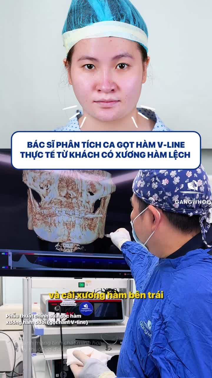 Bác sĩ trực tiếp phân tích ca gọt hàm V-line