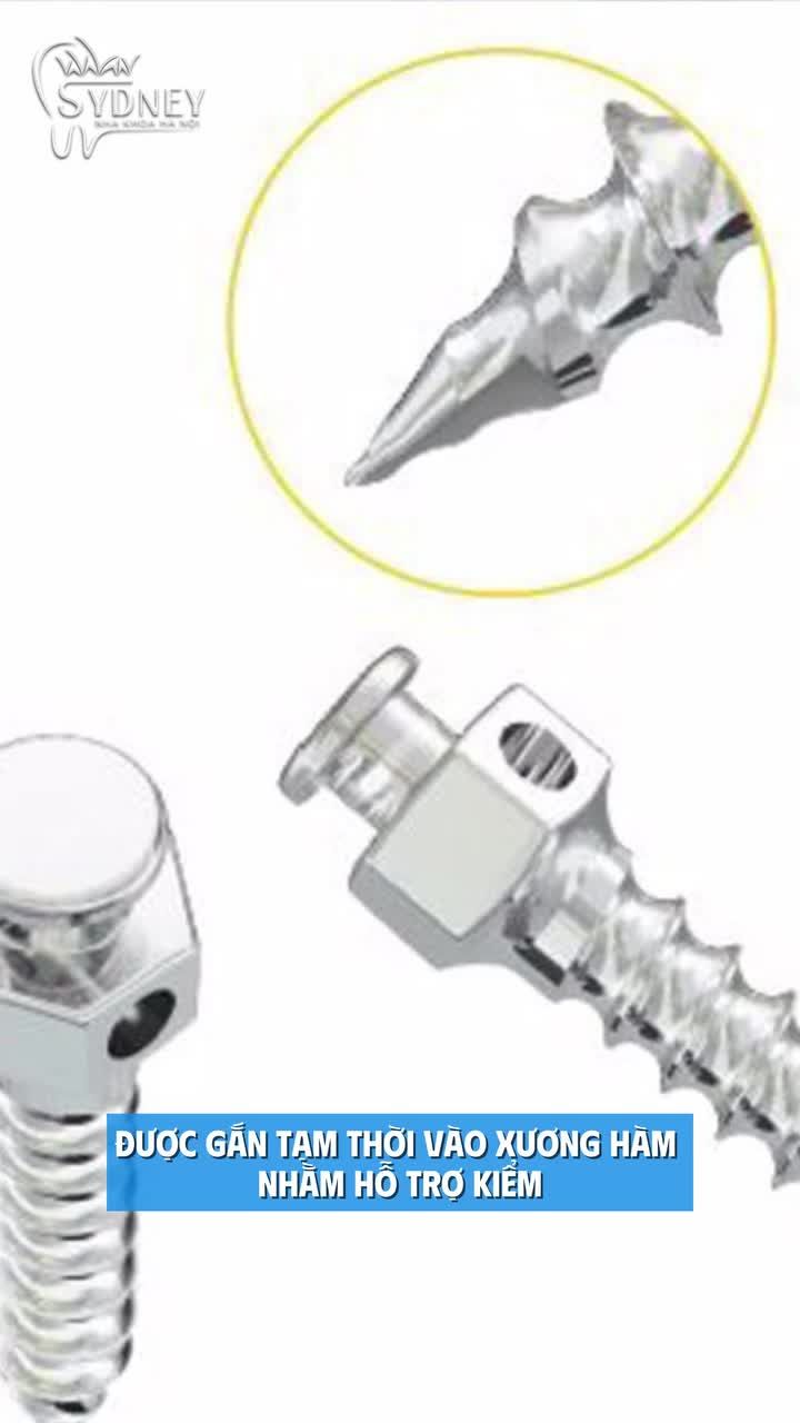 Minivis được sử dụng trong chỉnh nha để làm gì?