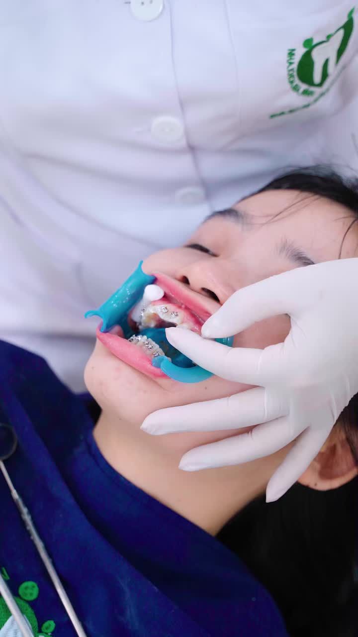 NIỀNG RĂNG CHO KHÁCH HÀNG TRẦN THỊ HUẾ