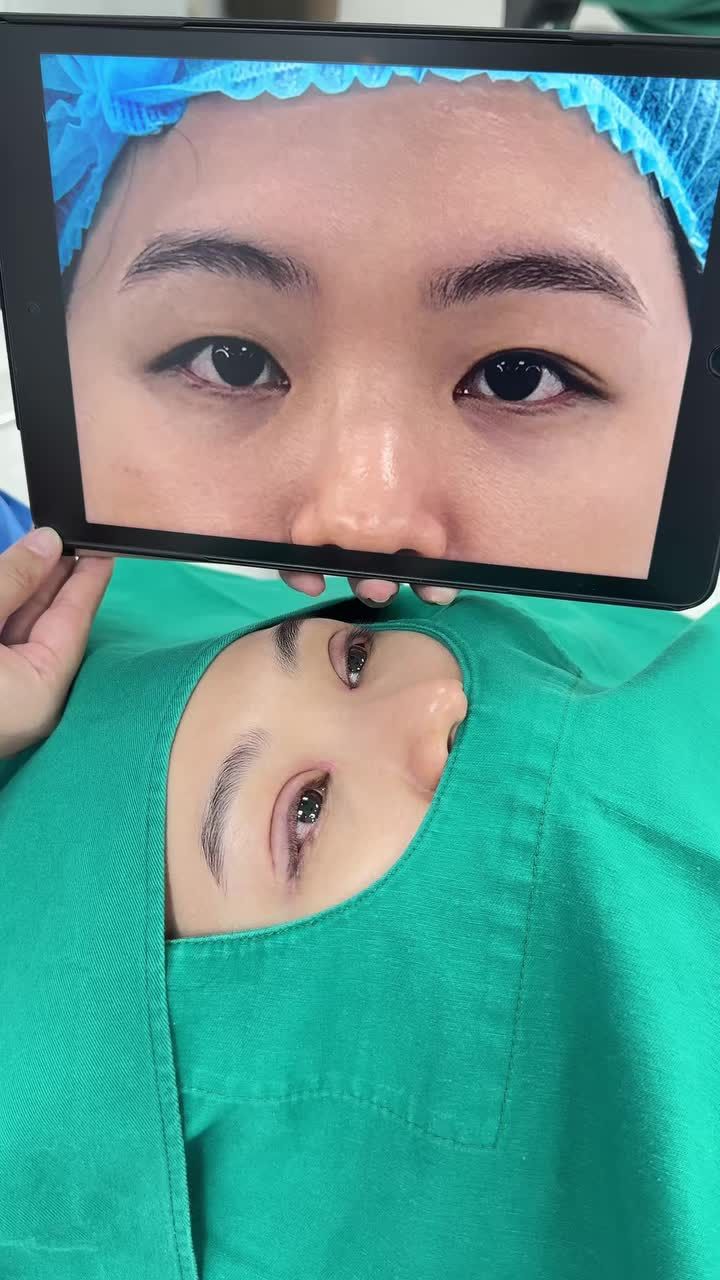 Sau khi thực hiện Combo Perfect Eyes cắt mí trên và mở góc trong, bạn khách đã “lột xác” rõ rệt: