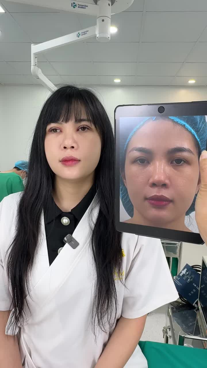 Hình ảnh chị khách hàng có tình trạng mí không đều, góc mắt tù, nếp mí dẻ quạt và da dư trùng nhiều.