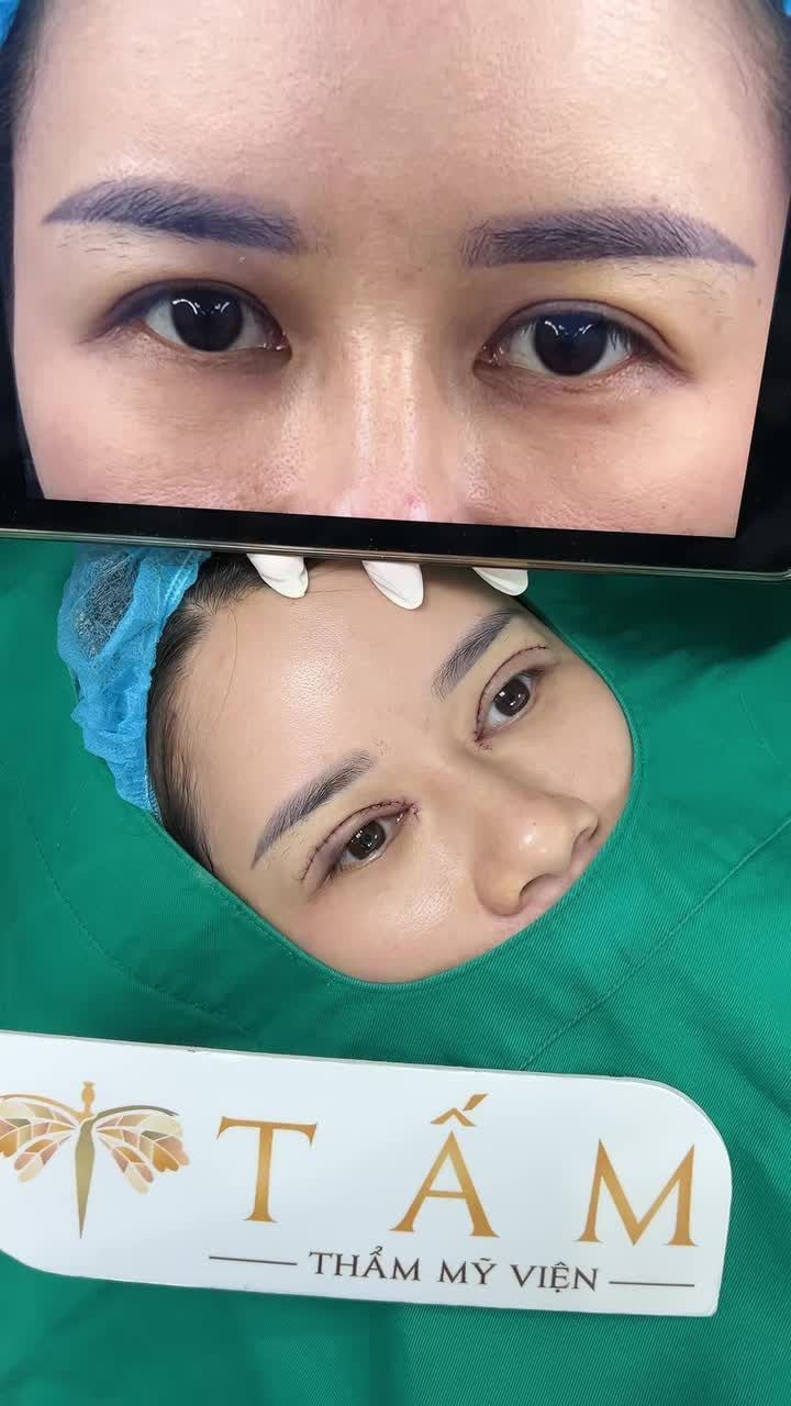 Hình ảnh ban đầu cho thấy đôi mắt của bạn khách hàng có phần góc trong cụp buồn, nếp mí sụp và chưa từng can thiệp thẩm mỹ nên khá e ngại, đặc biệt là cảm giác sợ đau.
