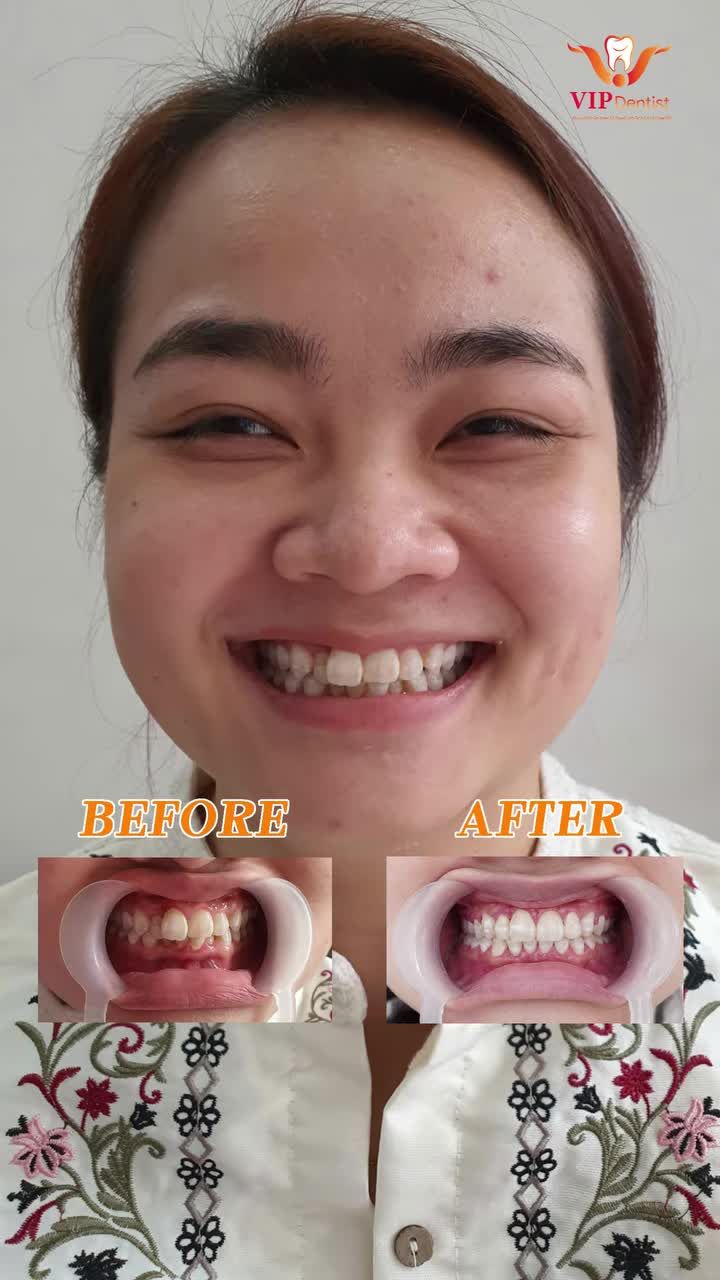 TOP 4 MÀN "LỘT XÁC" ĐỈNH CAO TẠI VIP DENTIST