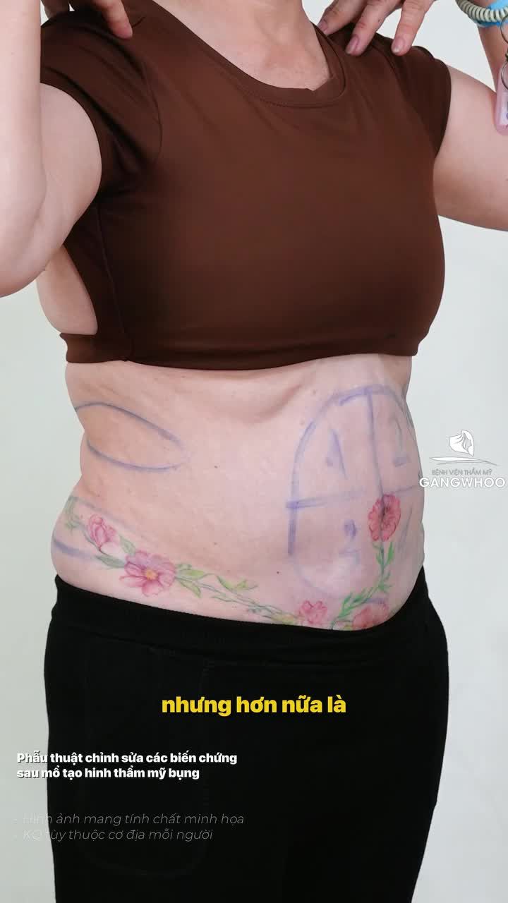 Sửa lại vòng eo cho chị khách sau 2 lần trải nghiệm giảm mỡ không như ý