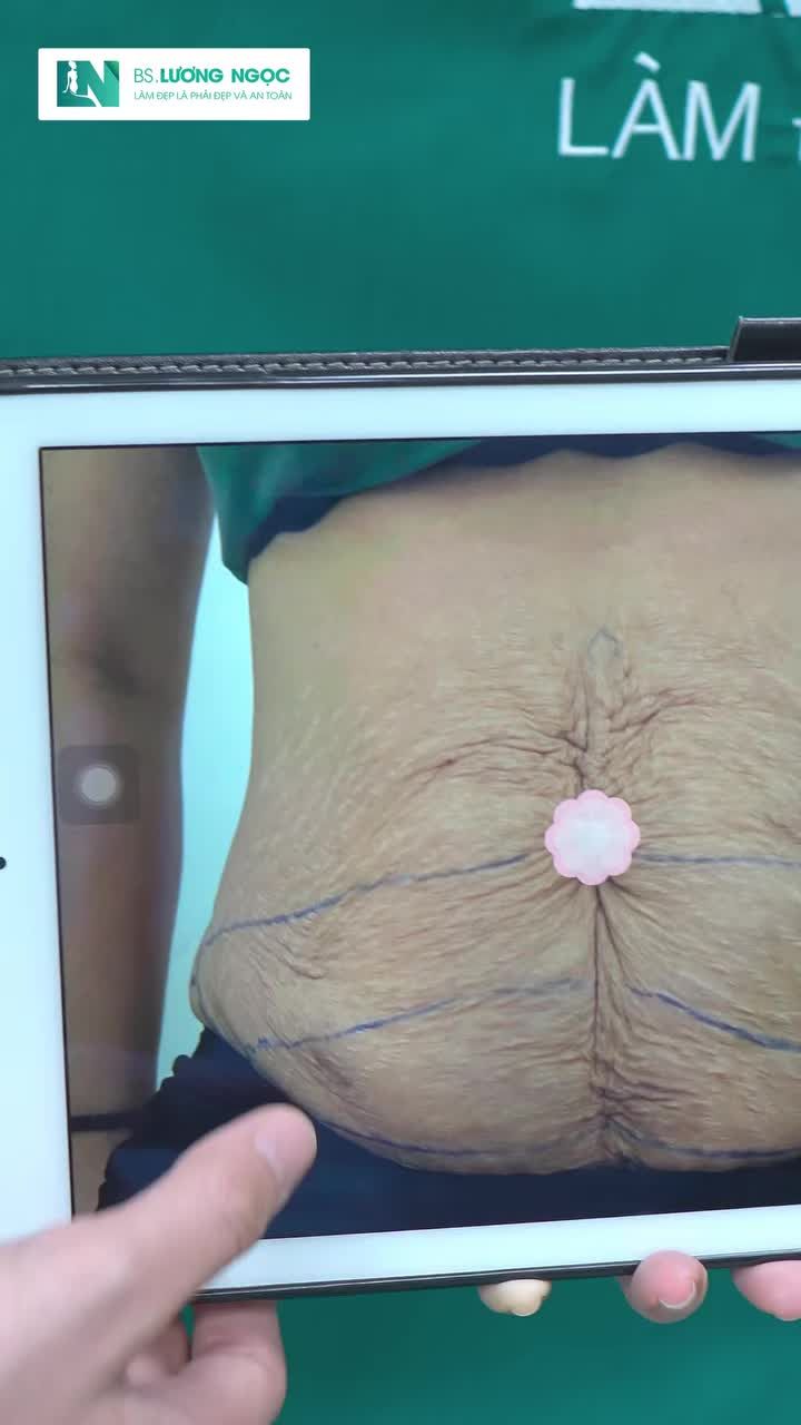 VÙNG DA BỤNG NHĂN VÀ CHÙNG NHÃO CÓ THỂ CẢI THIỆN SAU HÚT MỠ, TIN ĐƯỢC KHÔNG?