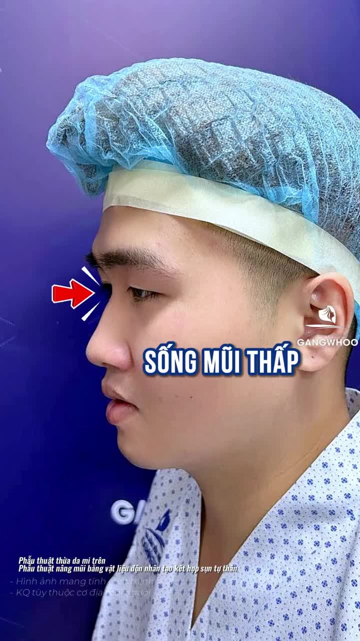 Quyết định nâng cấp bản thân với combo mắt và mũi, và đây là kết quả chỉ sau 2 tuần thực hiện.