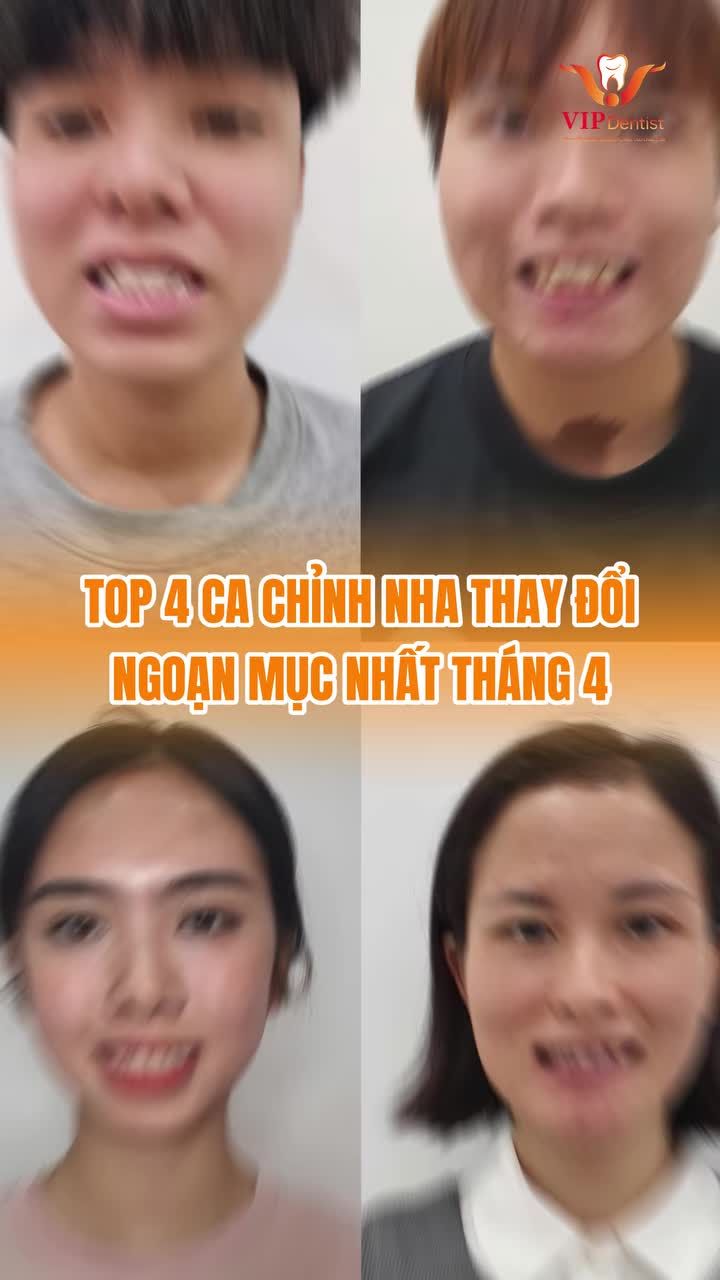 NHỮNG SỰ THAY ĐỔI NGOẠN MỤC ĐẾN KHÓ TIN CÙNG NIỀNG RĂNG KHÔNG NHỔ RĂNG TẠI VIP DENTIST.