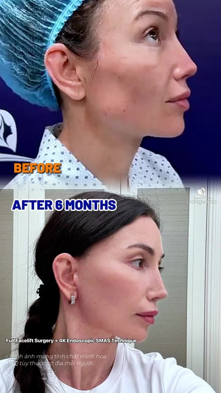 Sau 6 tháng phẫu thuật căng da mặt toàn phần + Smas nội soi 4K khách Úc đã thay đổi như thế nào?