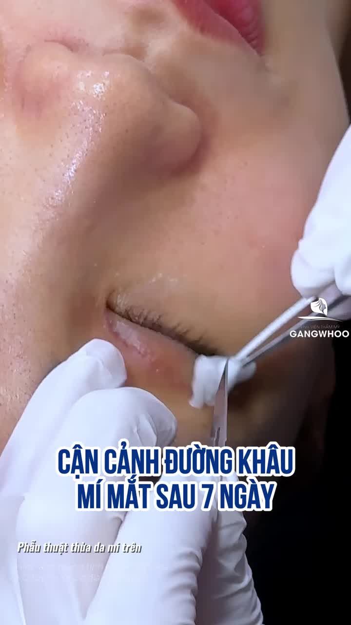 Cận cảnh đường khâu mí mắt sau 7 ngày. Rất nhiều khách hàng đã thay đổi rõ rệt sau 7 ngày cắt mí.