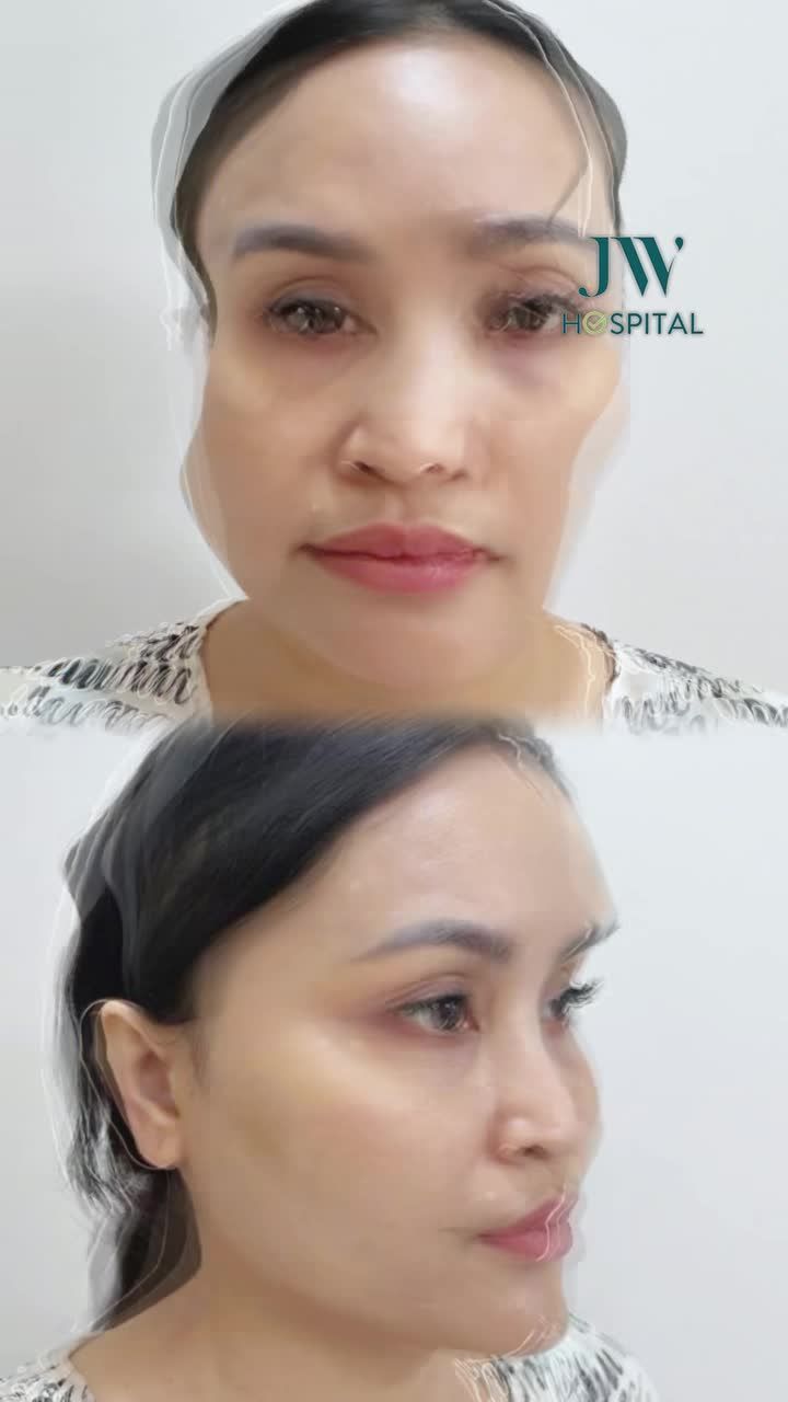 CHỊ GÁI 8X RÚT CHỈ + ĐẶT SÓNG CÓ MŨI S LINE ĐẸP CAO SANG QUÝ PHÁI TẠI JW