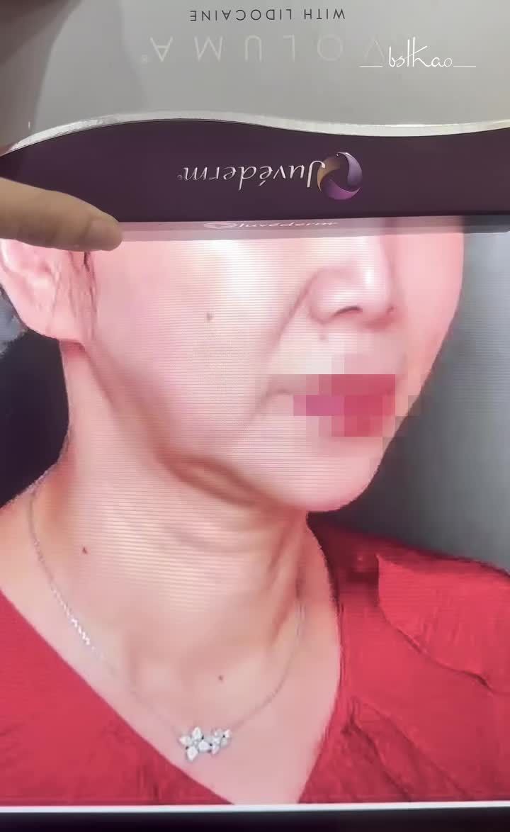 VÙNG MÁ C.HẢY X.Ệ NHIỀU, DÙ ĐÃ THỰC HIỆN NHIỀU PHƯƠNG PHÁP NHƯNG KHÔNG HIỆU QUẢ THÌ NÊN LÀM GÌ?