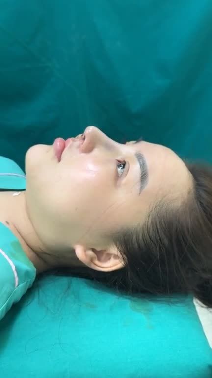 MŨI CẤU TRÚC RÚT CHỈ VỪA HOÀN THÀNH