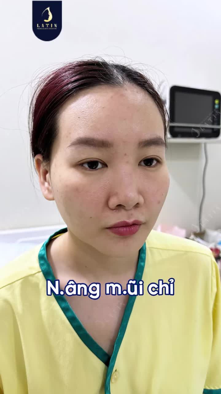 TÔI ĐÃ LÀM NHỮNG GÌ TRƯỚC KHI SỬA MŨI?