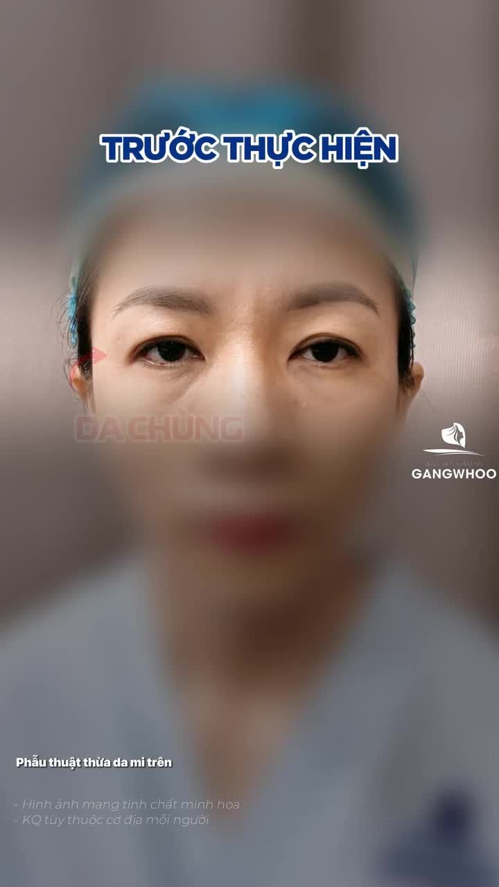 Chỉ sau 45 phút, da chùng được loại bỏ và đường mí mới được định hình rõ nét. Kết quả là đôi mắt hài hòa, sắc nét và tự nhiên.