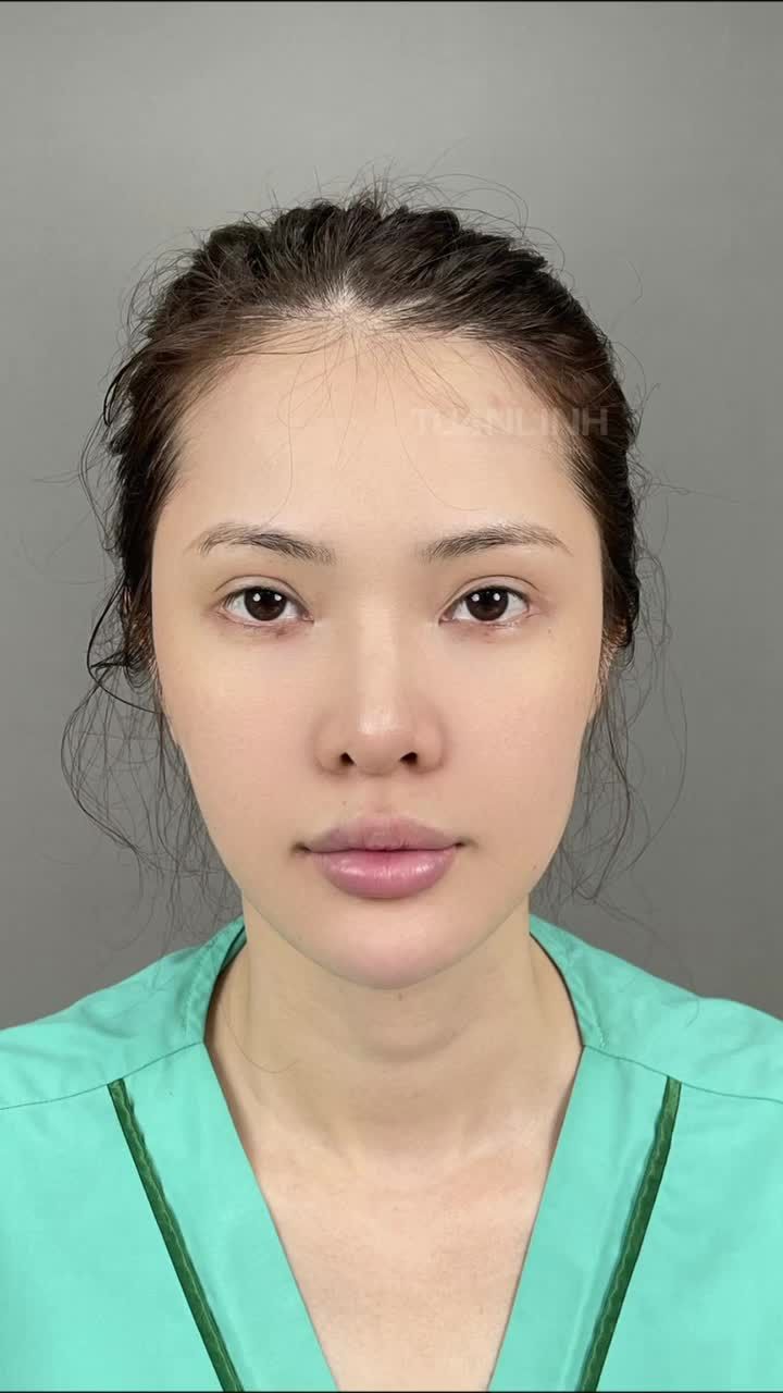 MŨI 10 NGÀY – ĐẸP XUẤT SẮC