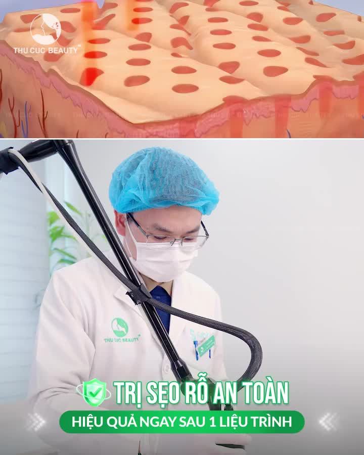 Ở đây có công nghệ trị sẹo rỗ hiệu quả tại Thu Cúc Nếu bạn đang gặp tình trạng: