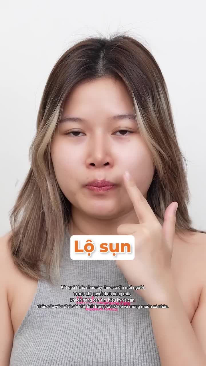 Cải thiện tình trạng mũi l.ệch, lộ sụn cho khách hàng #GenZ sau 5 năm nâng mũi nhân tạo.