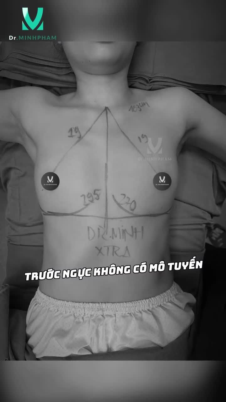 Từ vòng 1 chưa cân đối, thiếu độ đầy đặn  sau nâng cấp V1, khách hàng sở hữu diện mạo quyến rũ tự tin hơn rõ rệt