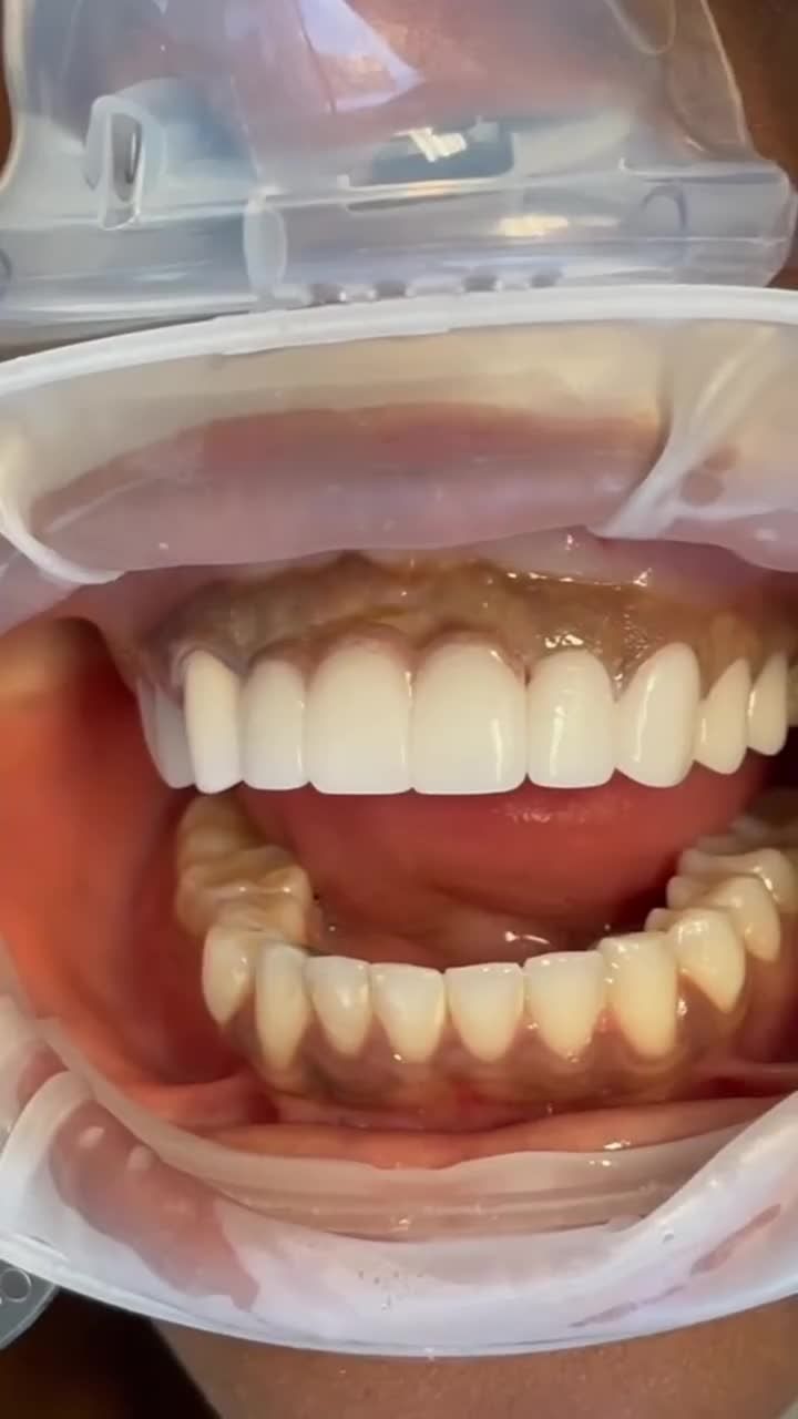 LÀM CẦU RĂNG SỨ HẾT BAO NHIÊU TIỀN