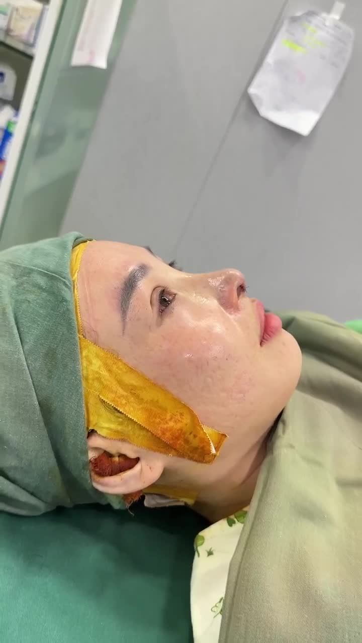KẾT QUẢ NÂNG MŨI CẤU TRÚC DR. HOẠT