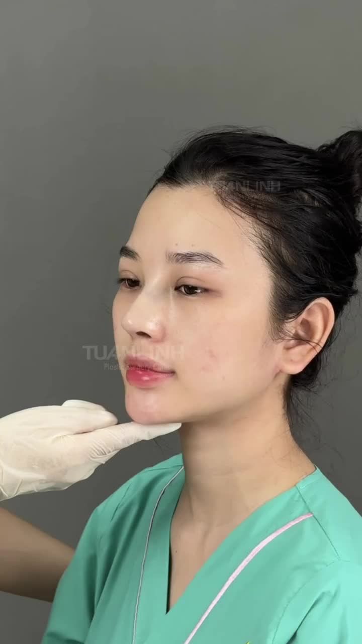 NÂNG MŨI BỌC SỤN – GIÁ CHỈ 17TRIỆU, ĐẸP XUẤT SẮC!!